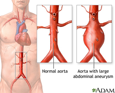varicose aorta
