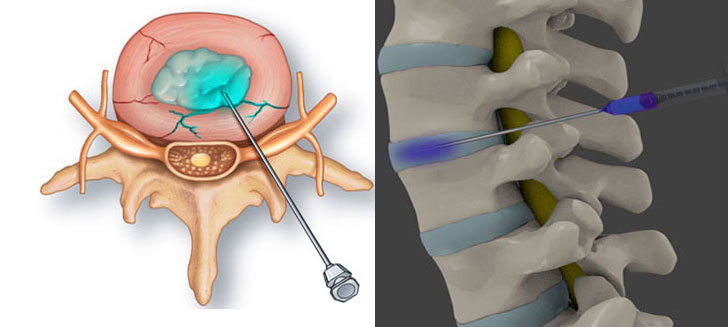 Ozone Therapy for Herniated Discs