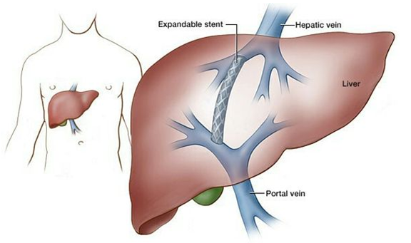 Transjugular Intrahepatic Porto Systemic Shunts And Surgical Shunts