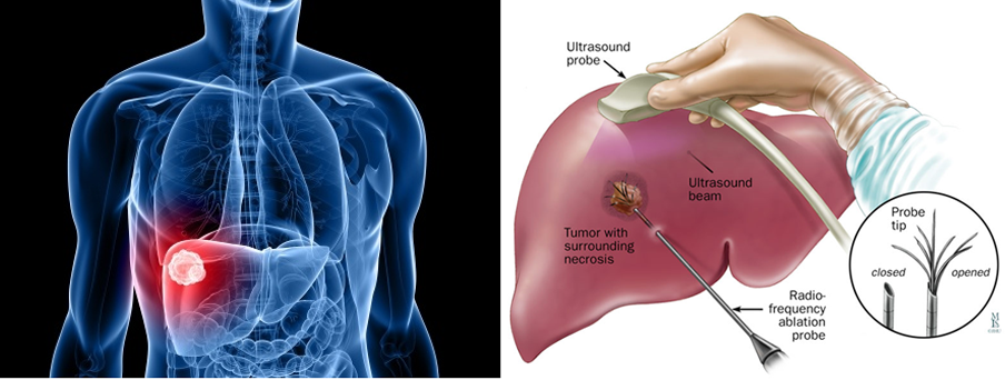 Chemoport Insertion, Varicose veins, Vascular surgeon, Stroke, DVT, Leg gangrene