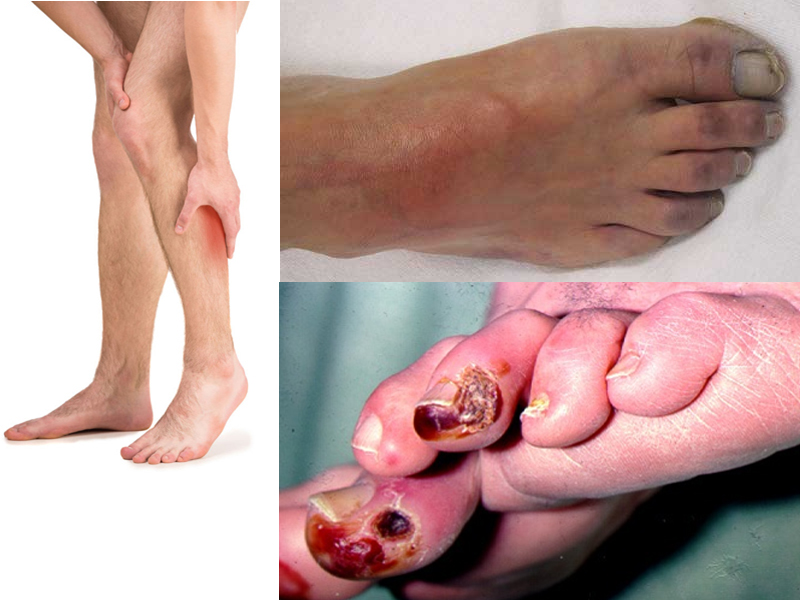 Peripheral Artery Disease (PAD): Symptoms & Treatment