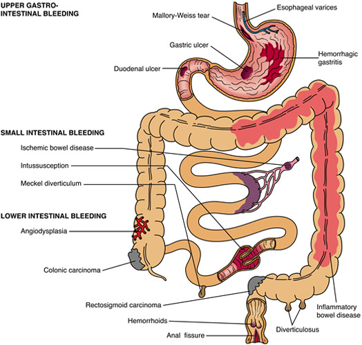 lower-gi-bleeding-the-3-steps-to-take-when-you-aren-t-sure-of-the