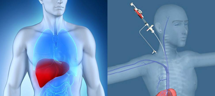 Chemoport Insertion, Varicose veins, Vascular surgeon, Stroke, DVT, Leg gangrene