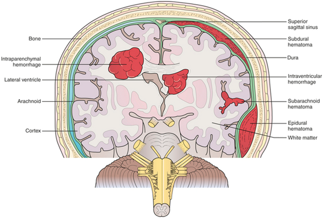 Bleeding (hemorrhage) in the brain - Pictures
