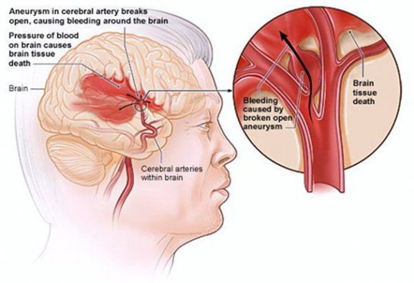 Brain Hemorrhage | Varicose veins | Vascular surgeon | Stroke | DVT ...