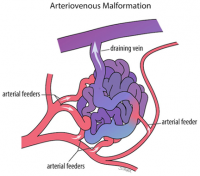 AVM | Varicose veins | Vascular surgeon | Stroke | DVT | Leg gangrene ...