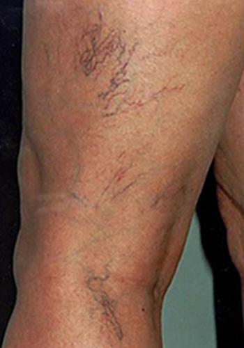 What are Spider Veins