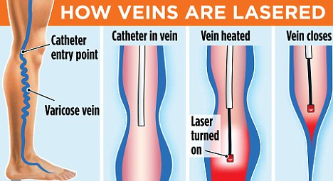 What is best treatment for varicose veins