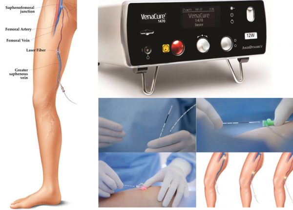 Laser treatment mumbai | VIR Clinic | Varicose veins doctor Thane