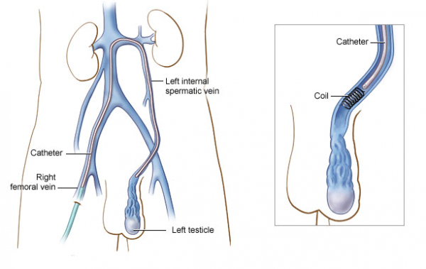 Varicocele Varicose Veins Vascular Surgeon Stroke Dvt Leg Gangrene Cancer