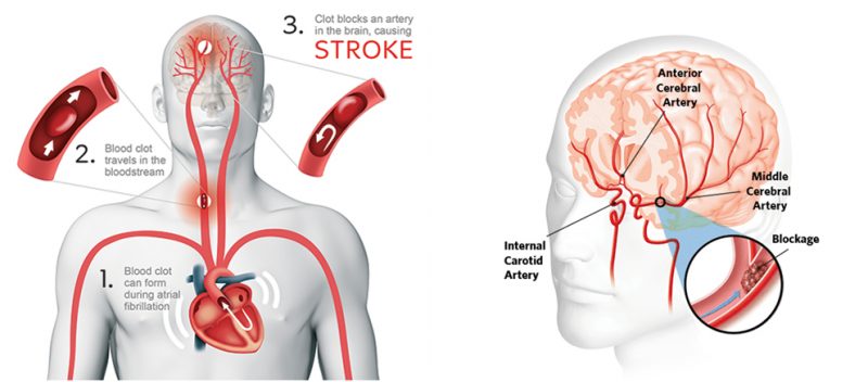 Acute Ischemic Stroke Varicose Veins Vascular Surgeon Stroke DVT Leg Gangrene Cancer