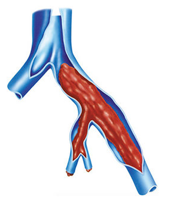 What is Deep vein thrombosis