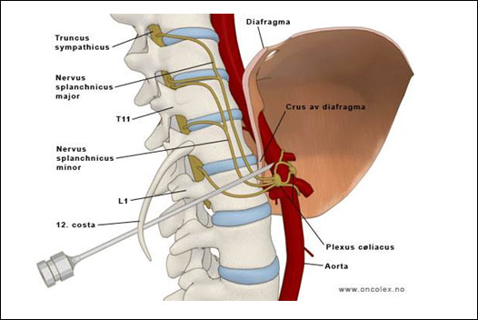 Percutaneous Management of Visceral pain
