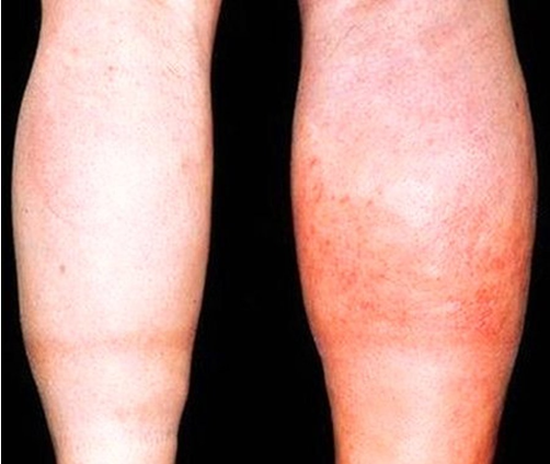 What are symptoms of DVT
