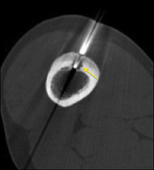 Radiofrequency ablation of Osteoid Osteoma