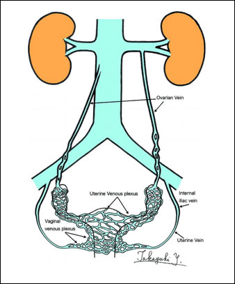 Chronic pelvic pain in women