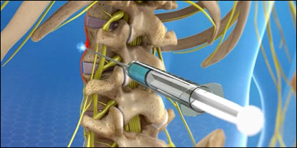 Sympathetic nerve block