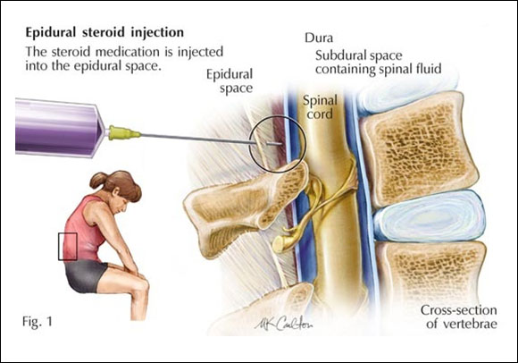 Epidural injections (in allareas of the spine)