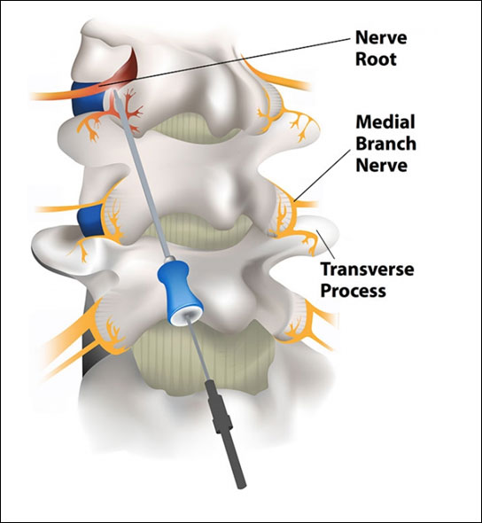 Selective Nerve, root, and medial branch blocks