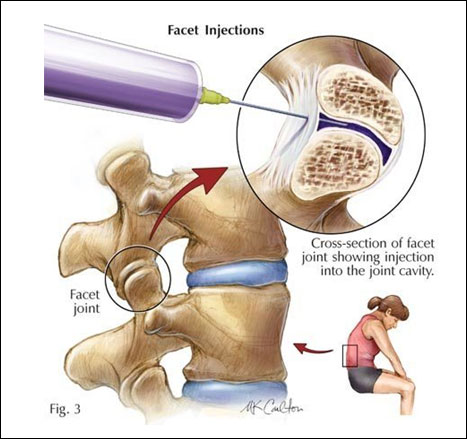 Facet joint injections