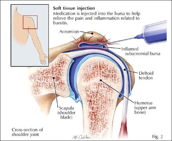 Articular interventions in pain management
