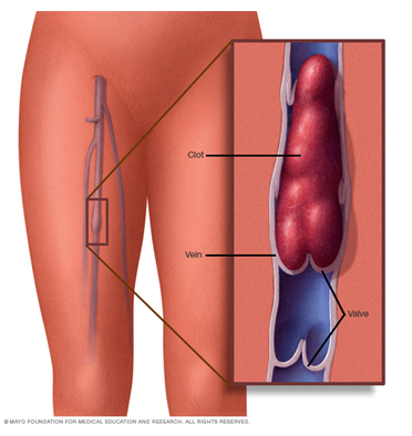 What is Deep vein thrombosis