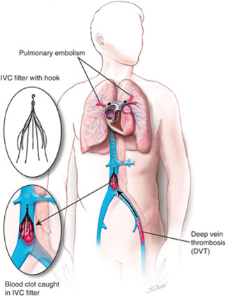 IVC-Filter