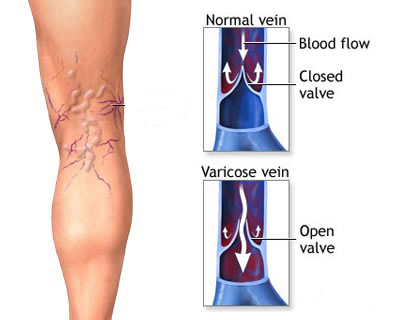 Varicose-Veins