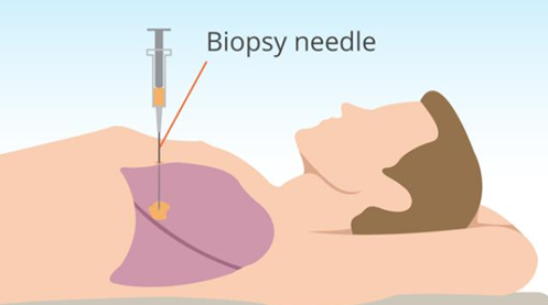 biopsy needle
