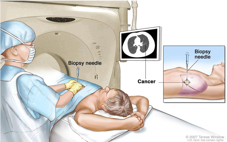 What is an image-guided biopsy?