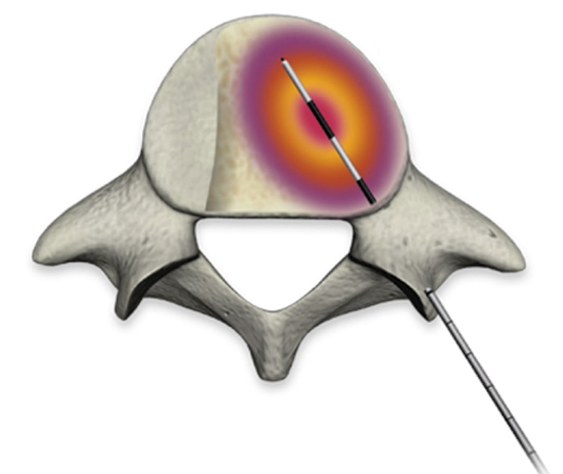 Bone cancer