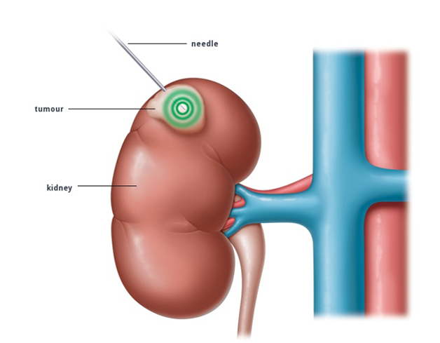 Kidney cancer