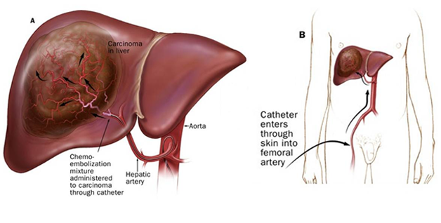 Liver cancer