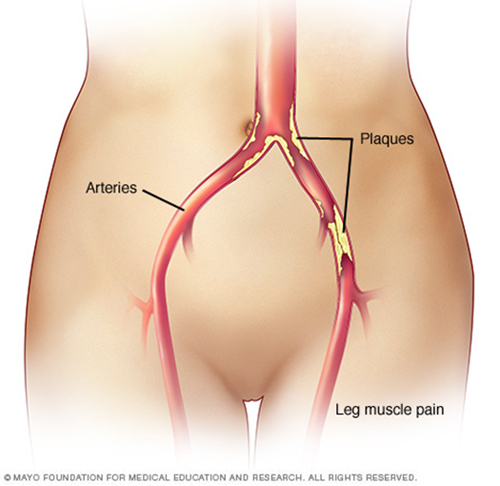 What is peripheral arterial disease