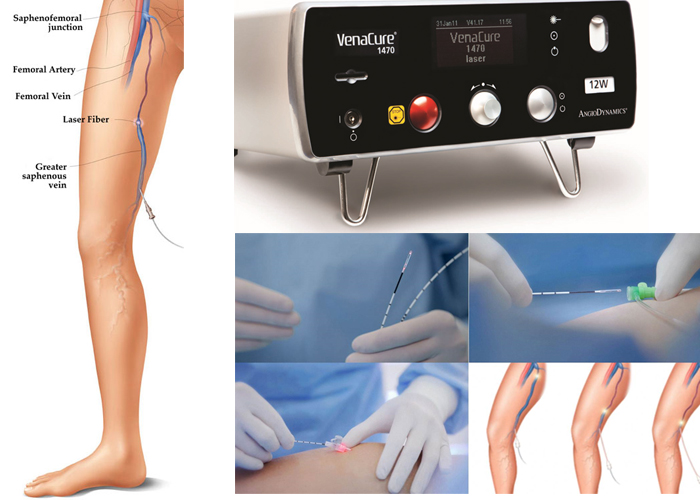 treatment-for-varicose-veins